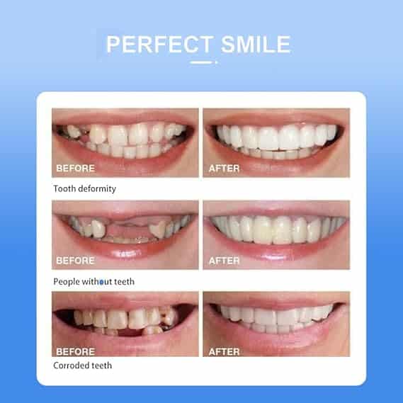 Snap On Smile Veneers Teeth For Men And Women Moldable False Artificial Braces Teeth